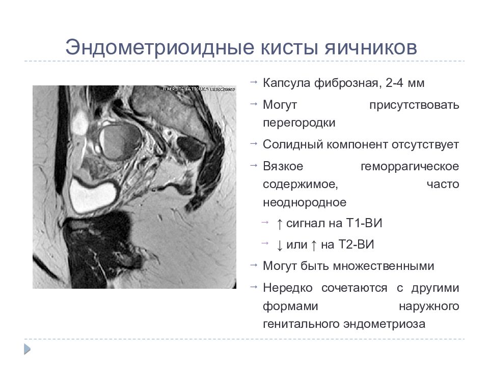 Геморрагическая киста. Дермоидная киста яичника мрт. Эндометриоидная киста мрт. Эндометриоидная киста яичника мрт. Эндометриома яичника мрт.