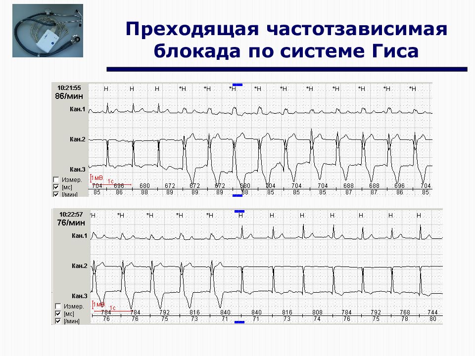 Преходящий. Блокада правой ножки пучка Гиса Холтер. Преходящая полная блокада левой ножки пучка Гиса на Холтере. Преходящая полная блокада правой ножки пучка Гиса на ЭКГ. Полная блокада левой ножки пучка Гиса на Холтере.