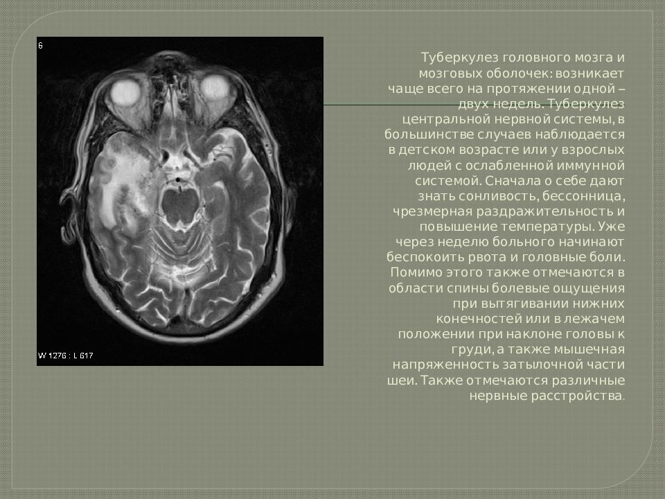 Туберкулез цнс презентация