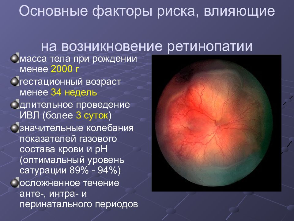 Ретинопатия недоношенных презентация