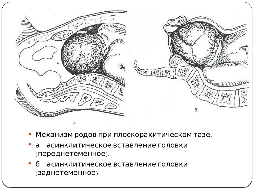 Вставление головки виды