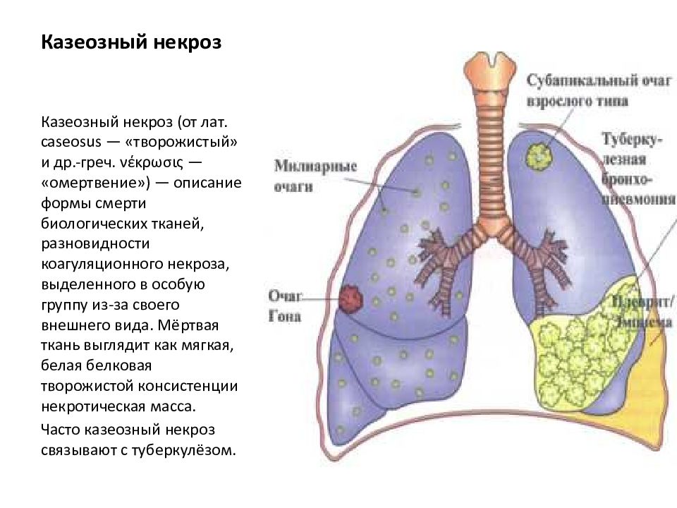 Казеоз это. Творожистый некроз туберкулез. Казеозный некроз гистол. Творожистый некроз легкого причины. Казеозный (творожистый) некроз.