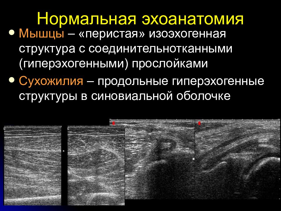 Изоэхогенное образование с четкими ровными контурами