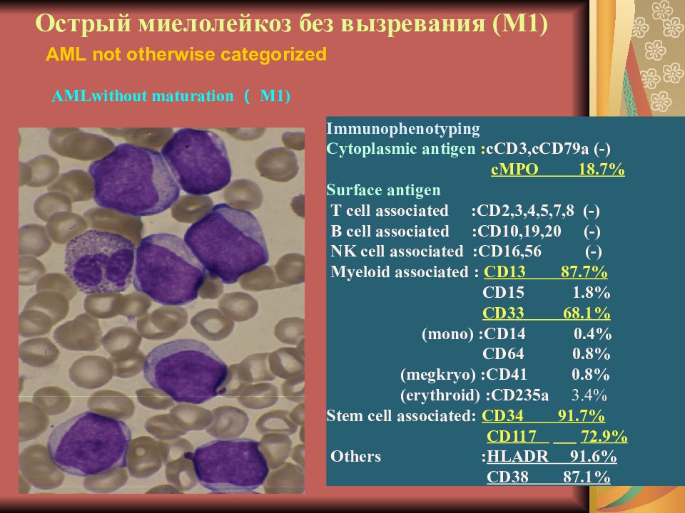 Картина крови при миелобластном лейкозе