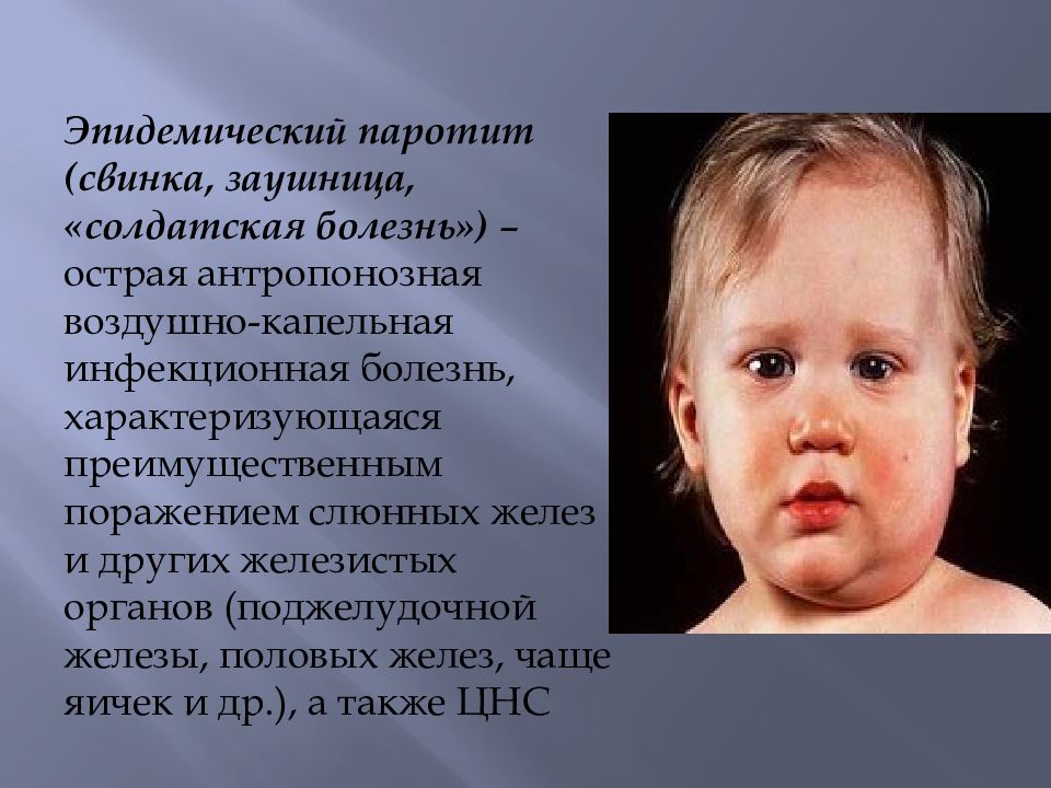 Свинка симптомы. Свинка эпидемический паротит. Эпидемический паротит Свинка болезнь. Эпидемический паротит Свинка заушница.