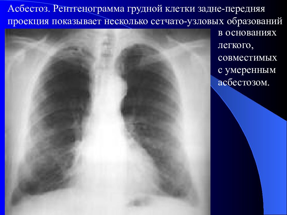 Асбестоз рентгенологическая картина