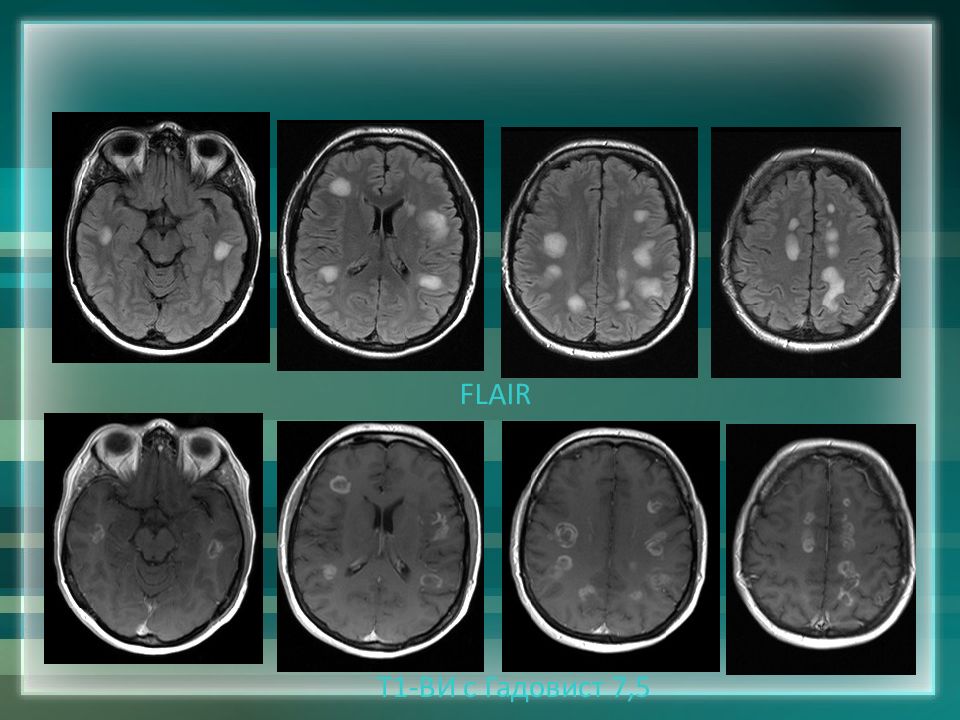 Мрт диагностика рассеянного склероза