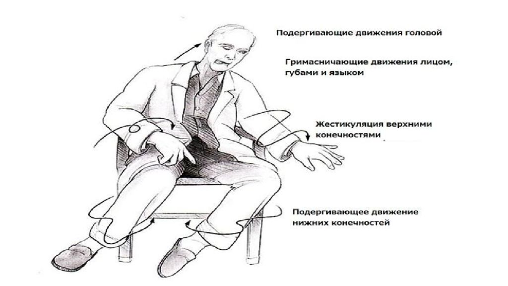 Хорея Гентингтона. Болезнь Хорея Гентингтона. Болезнь Хантингтона пляска Святого Витта.