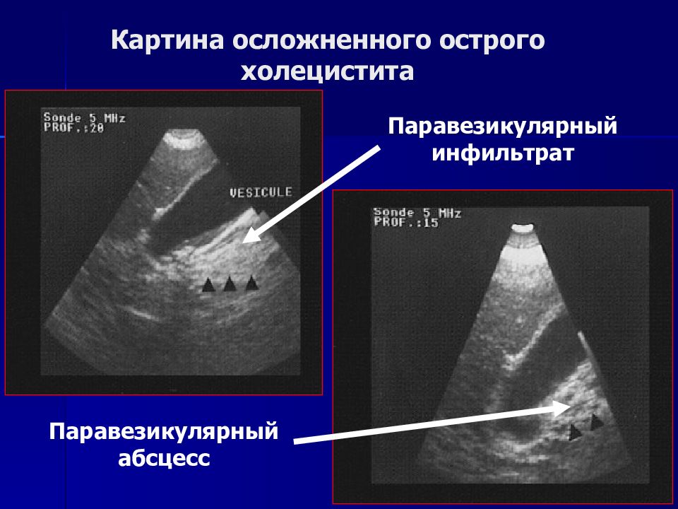 Абсцесс печени узи картина