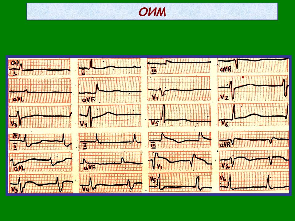 Оим. Заднебазальный инфаркт ЭКГ. Признаки инфаркта на ЭКГ. Заднебазальный им отведения.