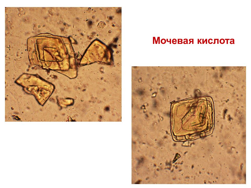 Мочекислый аммоний в моче фото под микроскопом