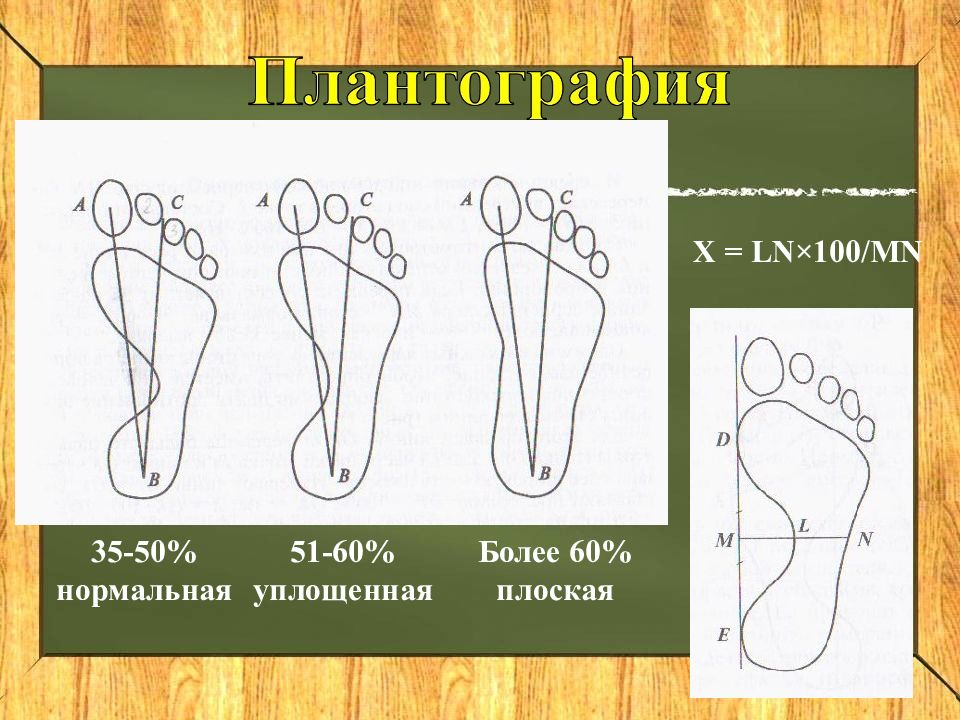 Плантография. Методика плантографии. Плантография методика проведения. Нормальная плантограмма.