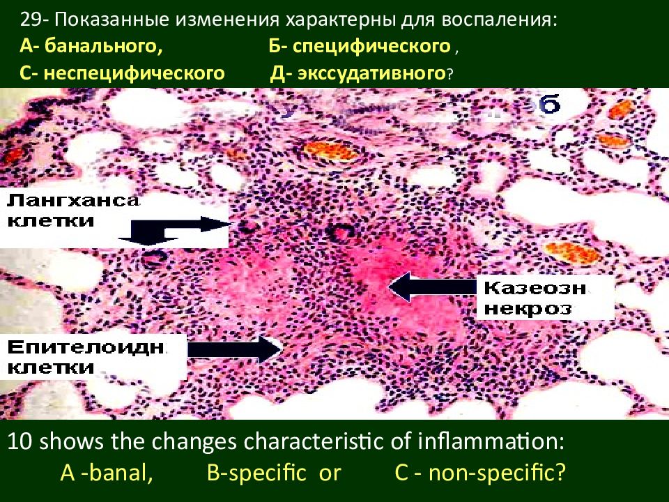 Воспаления теста. Воспаление патанатомия лекция. Для специфического воспаления характерно. Экссудативное воспаление патологическая анатомия. Воспаление патанатомия презентация.