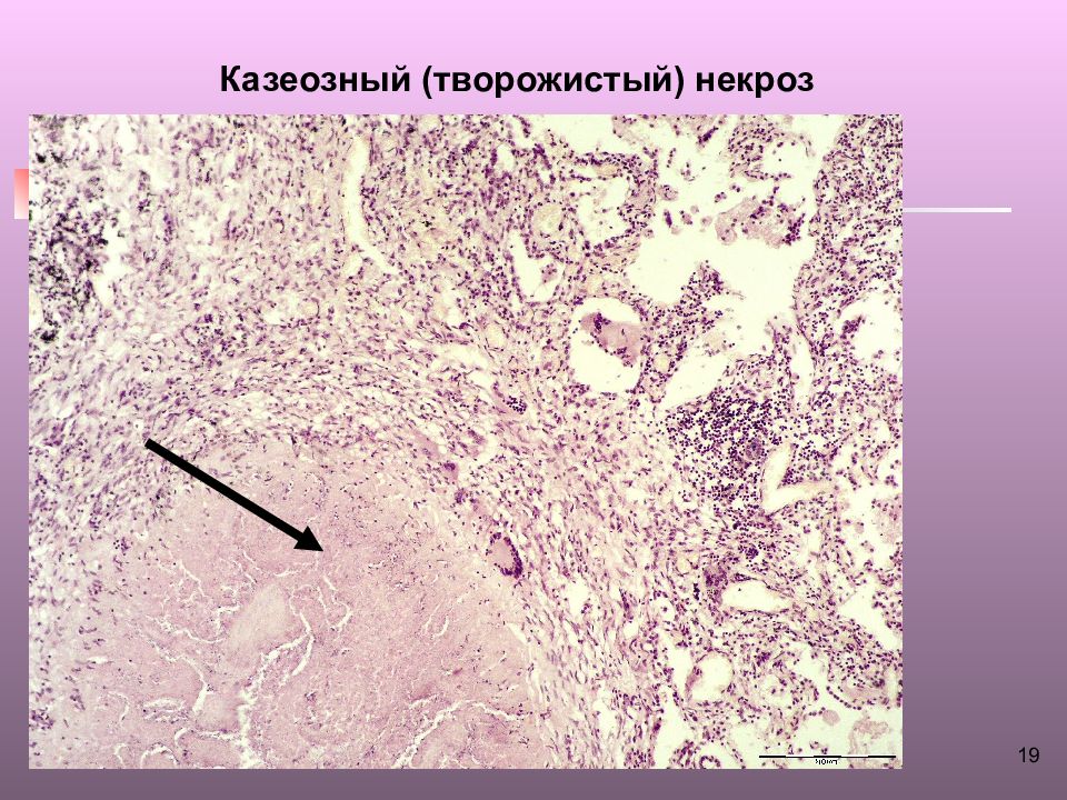 Туберкулезная каверна микропрепарат рисунок