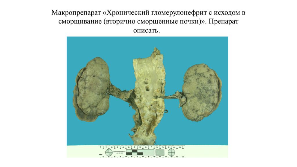 Первично и вторично сморщенная почка. Гломерулонефрит почки макропрепарат. Амилоидоз почки макропрепарат. Подострый гломерулонефрит макропрепарат. Хронический гломерулонефрит макропрепарат.