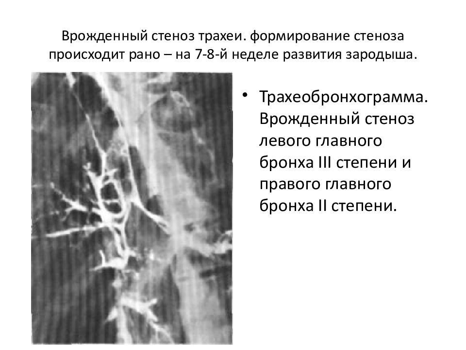 Пороки Развития Трахеи