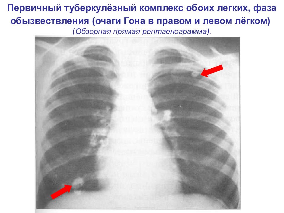 Что значат узелки в легких. Первичный туберкулезный комплекс очаг гона. Очаг гона на рентгенограмме. Первичный туберкулезный комплекс петрификация.