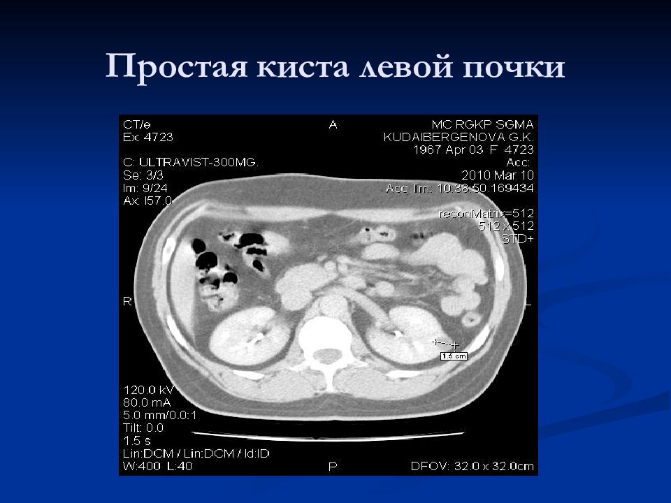 Киста лево. Простая субкапсулярная киста левой почки. Простая киста левой почки.