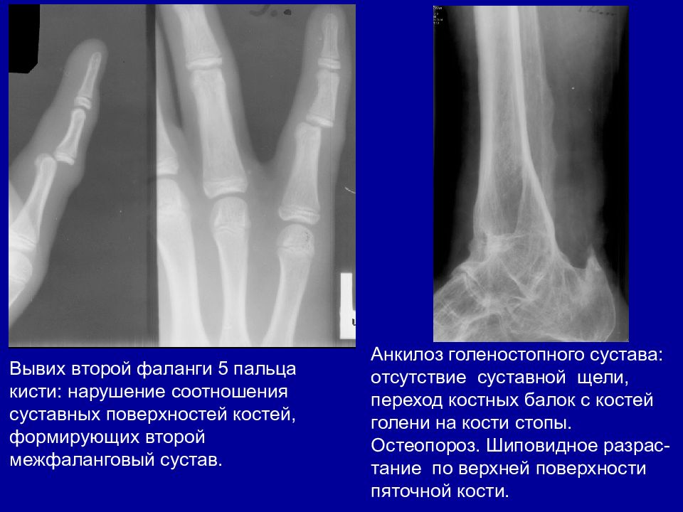 Анкилоз сустава. Фиброзно-костный анкилоз. Анкилоз сустава рентген. Костный анкилоз голеностопного сустава. Костный анкилоз на рентгене.