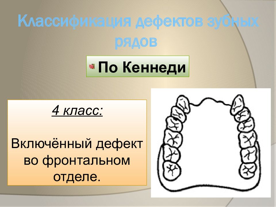 Дефекты зубных рядов. Классификация адентии по Кеннеди. Классификация зубных дефектов по Кеннеди. Классификация дефектов зубных рядов по Кеннеди. Классы по Кеннеди ортопедия.