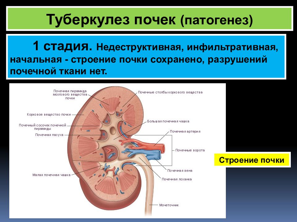 Изменения почек. Туберкулез паренхимы почек. Туберкулез паренхимы почек рентген. Поликавернозный туберкулез почки. Патогенез туберкулеза почек.