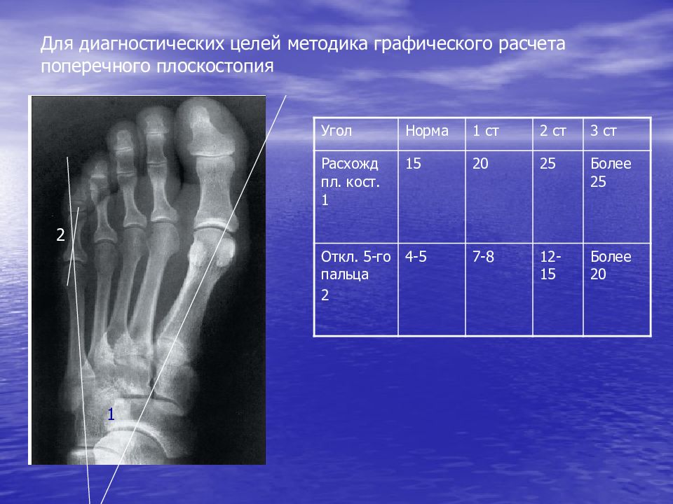 Углы стопы. Поперечное плоскостопие рентген. Поперечное плоскостопие рентген измерение. Угол между 1 и 5 плюсневыми костями норма. Поперечное плоскостопие норма рентген.