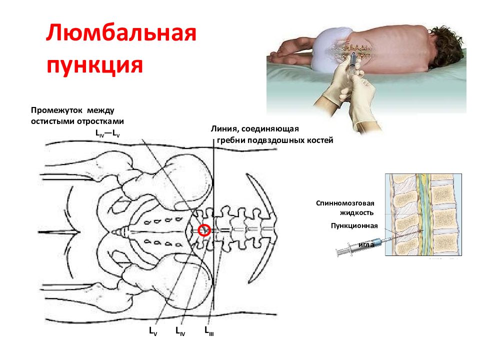 Люмбальная пункция схема. Осложнения люмбальной пункции. Люмбальная пункция при менингите. Люмбальная пункция норма.