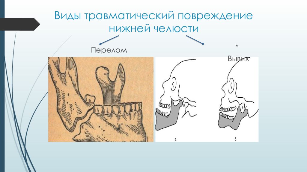 Закрытый перелом нижней челюсти карта вызова локальный статус