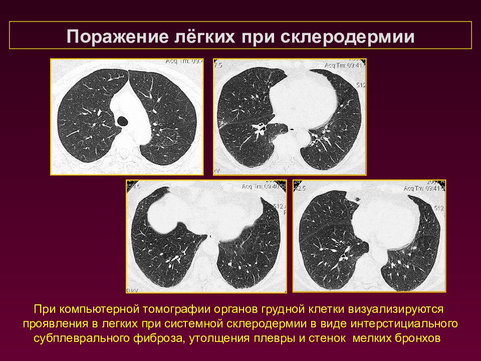 Поражение почек при системных заболеваниях презентация