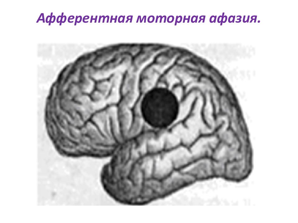 Эфферентная афазия. Афферентная кинестетическая моторная афазия. Афферентная моторная афазия клиническая картина. Топика поражения мозга при афферентной моторной афазии. Очаг поражения при афферентной моторной афазии.