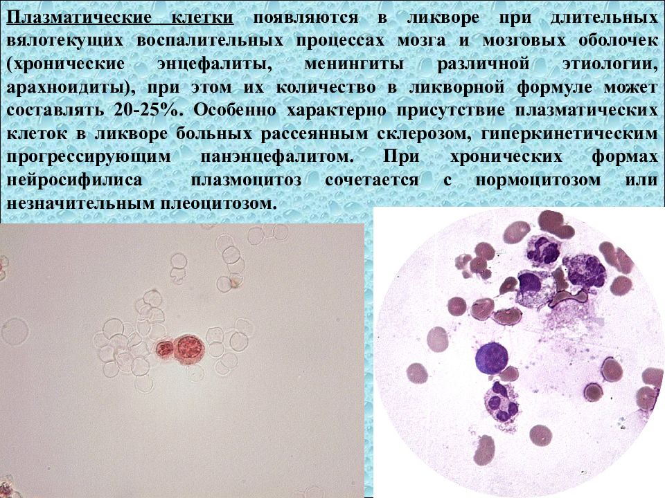 Плазматические клетки в ликворе. Плазматические клетки в СМЖ. Высокий белок в ликворе. Исследование ликвора.
