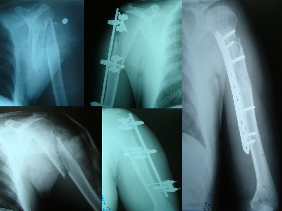 Перелом члена. Многооскольчатый перелом плечевой кости. Перелом метафиза плечевой кости. Субкапитальный перелом плечевой кости. Перелом плечевой кости мкб.