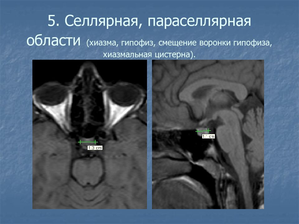 Мрт область. Опухоли селлярной области мрт. Супраселлярная цистерна мрт. Киста хиазмальной цистерны мрт. Образование воронки гипофиза мрт.