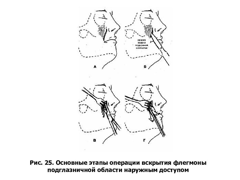 Абсцесс и флегмона