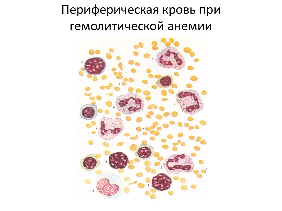 Гемолитическая анемия презентация