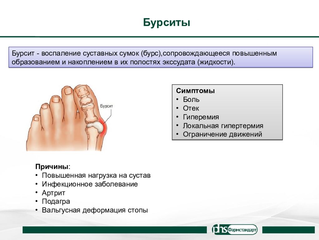 Воспаление суставной сумки. Воспаление суставной сумки стопы. Воспаление синовиальной сумки.