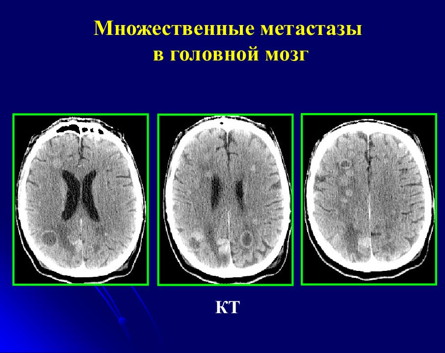 Метастазы в мозг прогноз. Метастатическое поражение головного мозга кт. Метастазы головного мозга кт. Множественные метастазы в головной мозг кт.