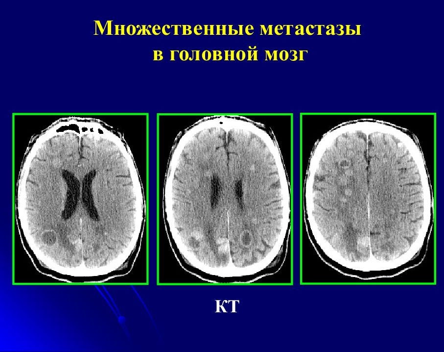 Метастазы в головном мозге симптомы. Метастазы головного мозга кт кт. Опухоли головного мозга кт снимки. Опухоль головного мозга метастазы.