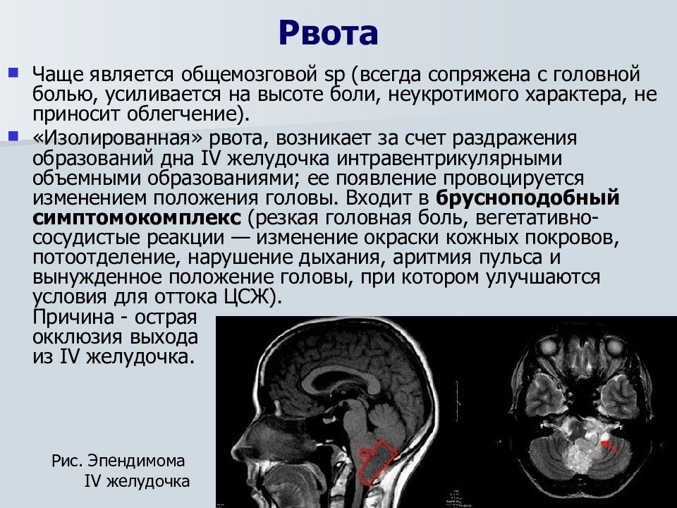 Рак головного мозга презентация