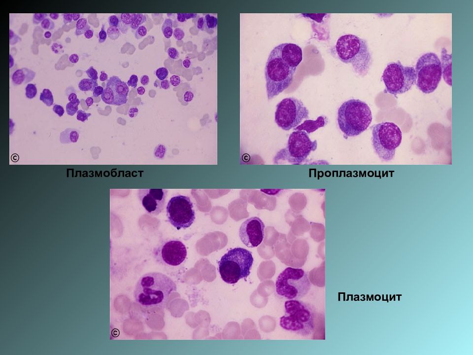 1 плазматическая клетка. Плазматические клетки плазмоциты. Плазматические клетки в крови. Плазматические клетки в мазке крови. Плазматические клетки в костном мозге.