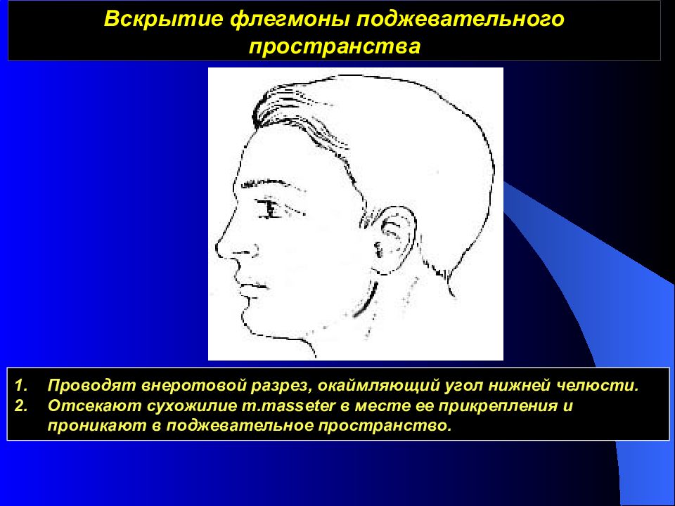 Под этн. Вскрытие флегмоны поджевательного пространства. Абсцесс и флегмона поджевательного пространства. Флегмона подмассетериального пространства. Окаймляющий угол нижней челюсти.