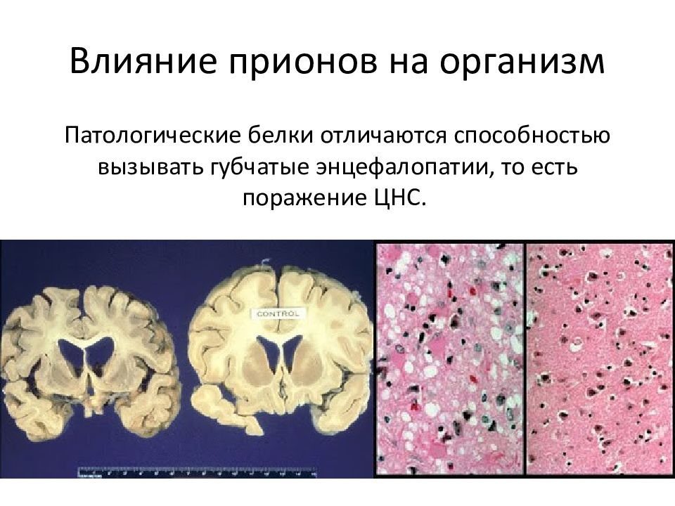 Прионные болезни презентация