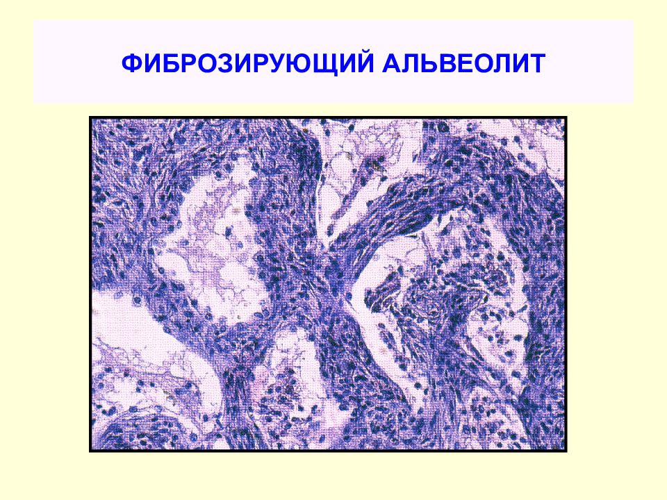 Презентация идиопатический фиброзирующий альвеолит