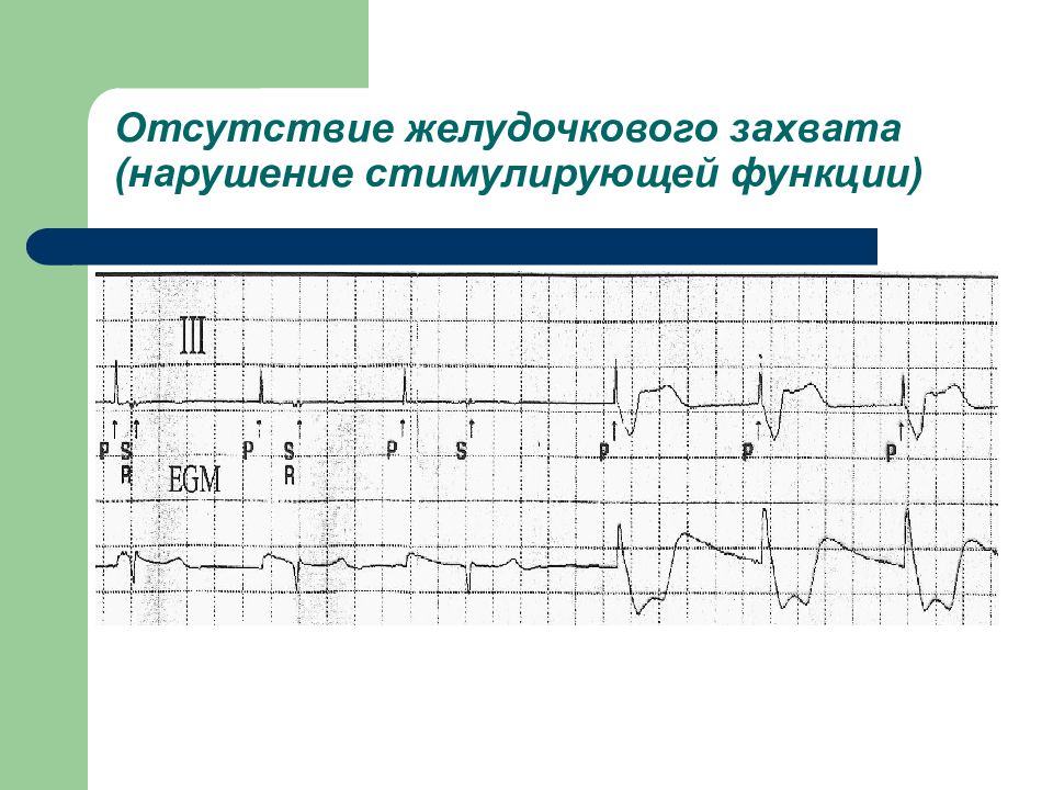 Желудочковые нарушения. Угрожающие нарушения ритма и проводимости. Нарушение желудочкового захвата. Ритм желудочкового экс. Экс нарушение функции стимуляции.