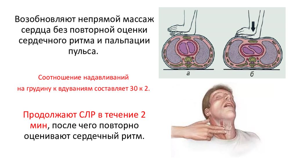 Сердечный 30. Расширенная сердечно-легочная реанимация. Расширенная СЛР. Непрямой массаж сердца 30. Непрямой массаж сердца 30 к 2.