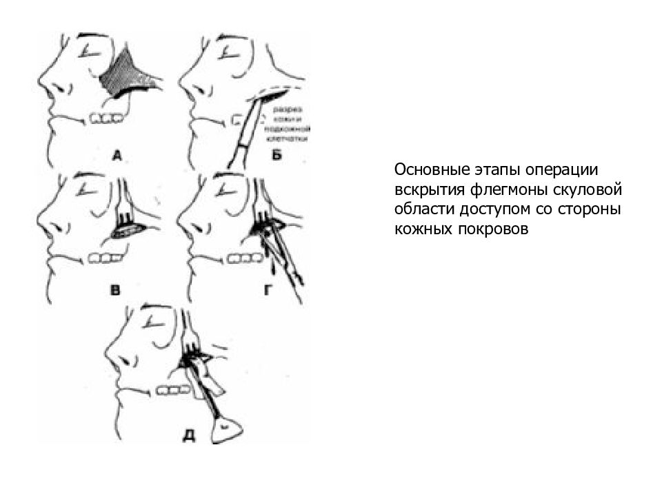 Абсцесс и флегмона. Флегмона скуловой области вскрытие. Вскрытие флегмон челюстно-лицевой области. Абсцессы и флегмоны прилегающие к верхней челюсти. Флегмоны челюстно-лицевой области схема.