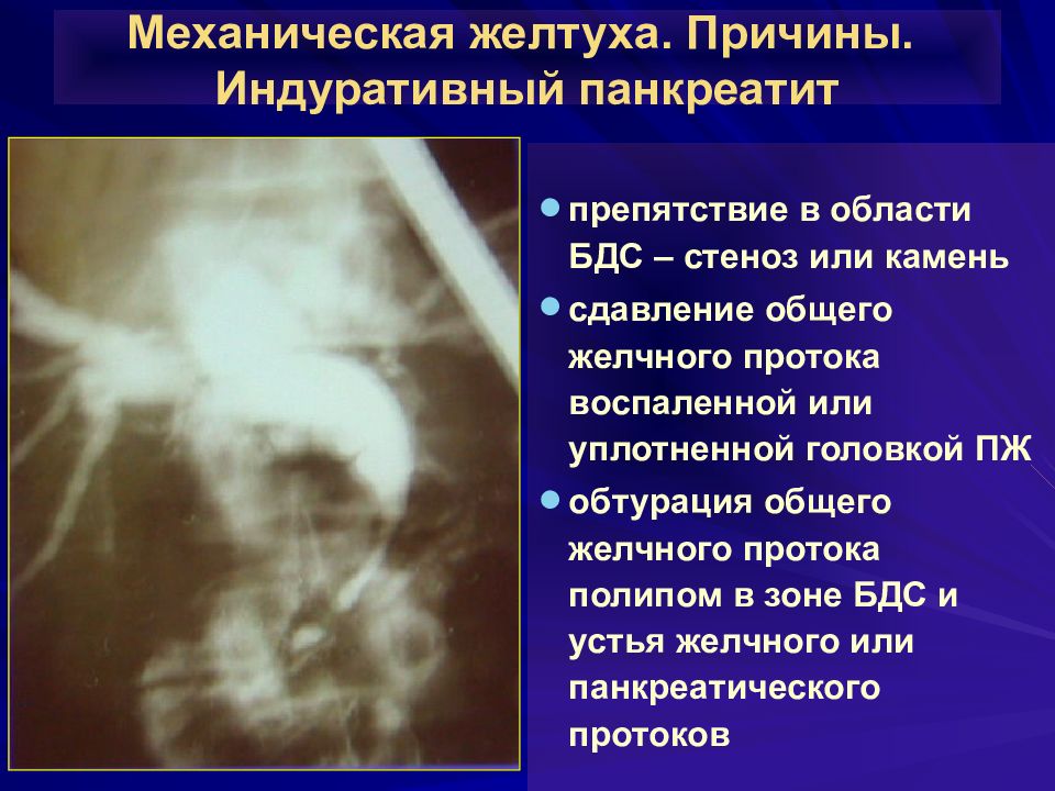 Эхографическая картина несмещаемого камня большого дуоденального сосочка