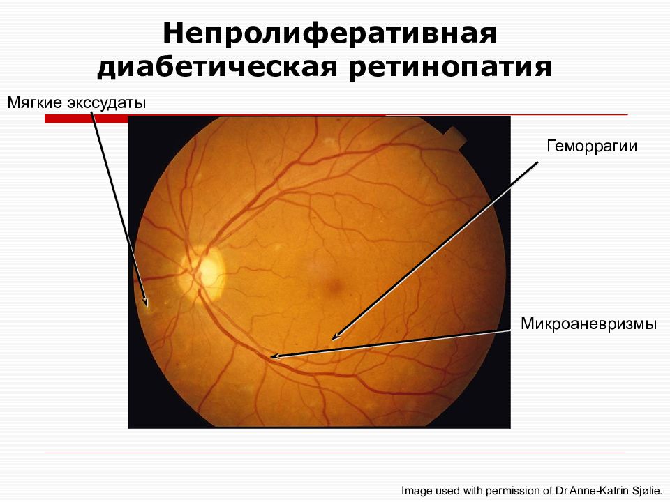 Диабетическая ретинопатия