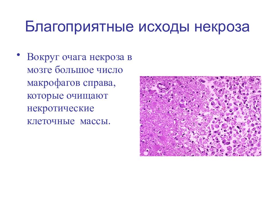 Некроз это простыми словами. Клинико-морфологическая характеристика некроза. Коагуляционный некроз тканей. Клинико-морфологические формы некроза. Некроз причины и формы.