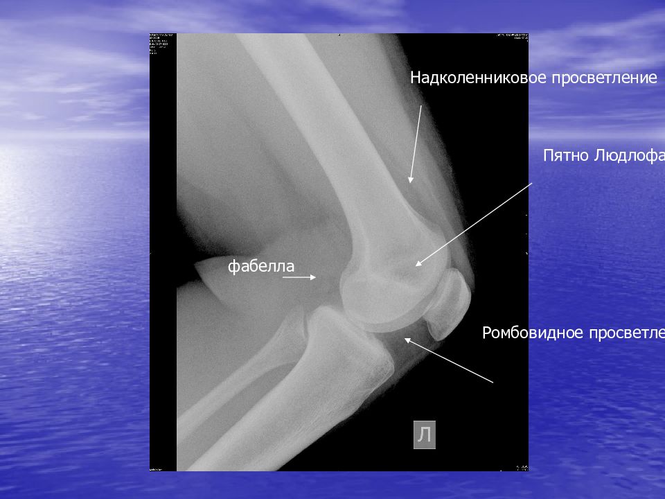 Изображение коленного сустава рентгеновское